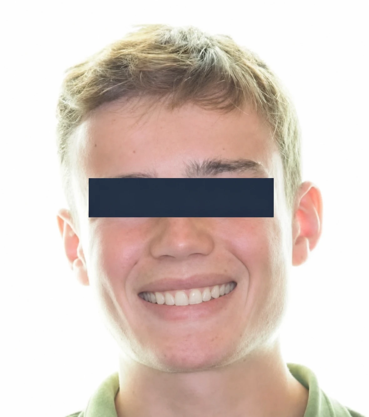 Après traitement orthodontique