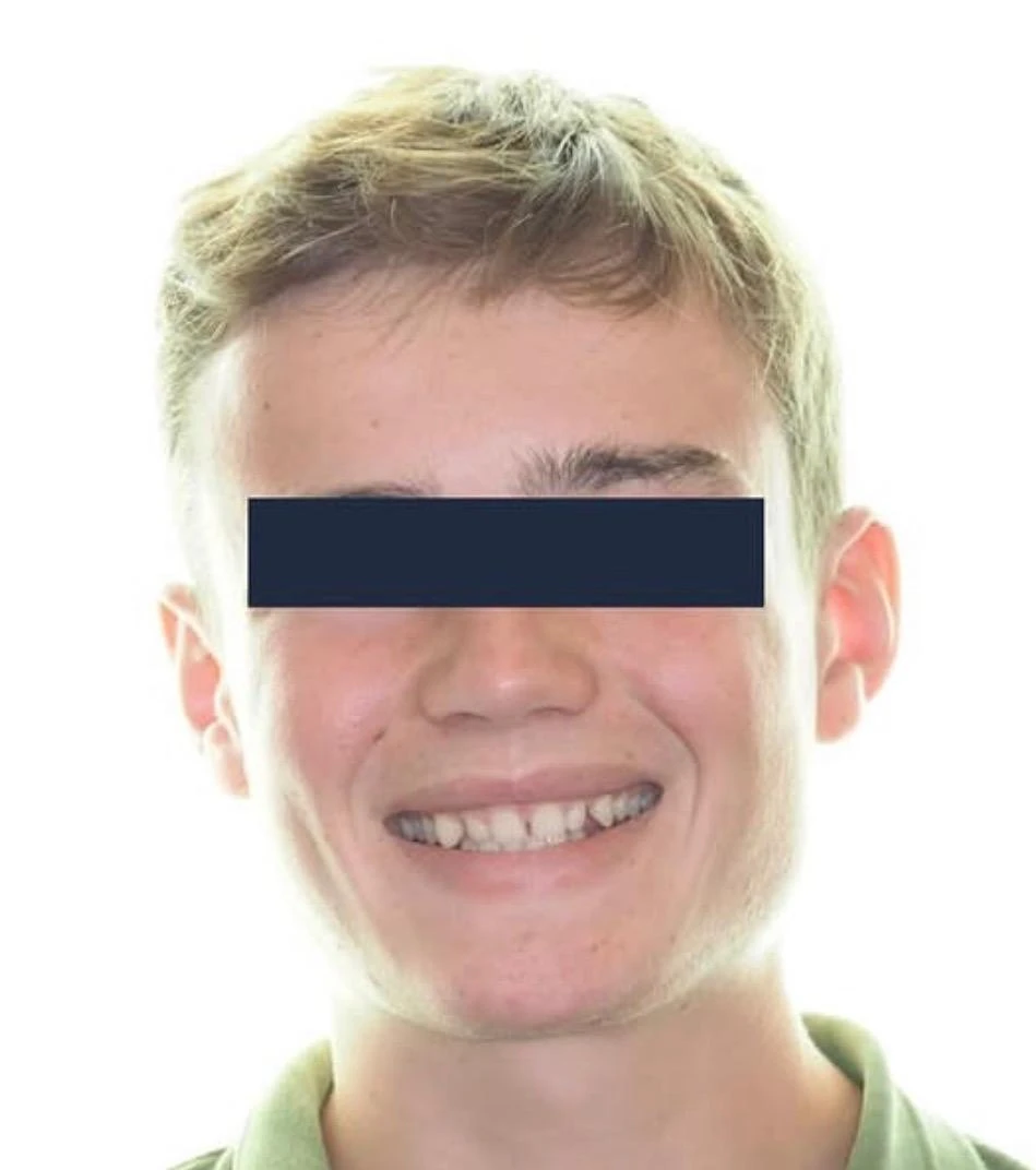 Avant traitement